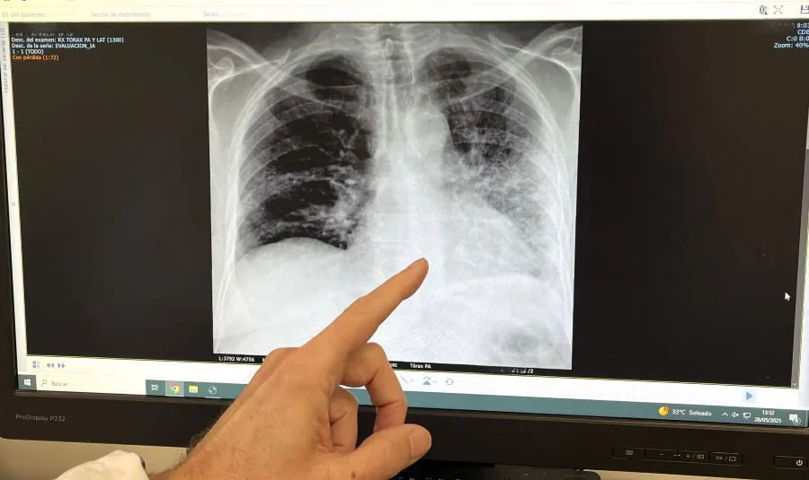 Foto RX paciente fumador con cáncer de pulmón